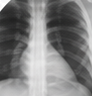 The real chest radiograph for the question